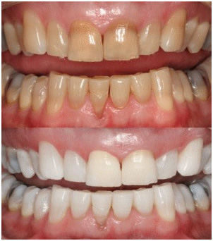 Lézeres fogfehérítés eredménye