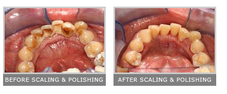 professszionális fogkőeltávolítás