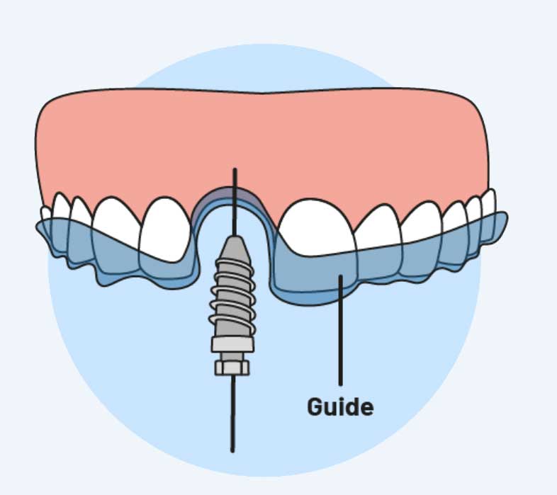 3Dvezerelt implant